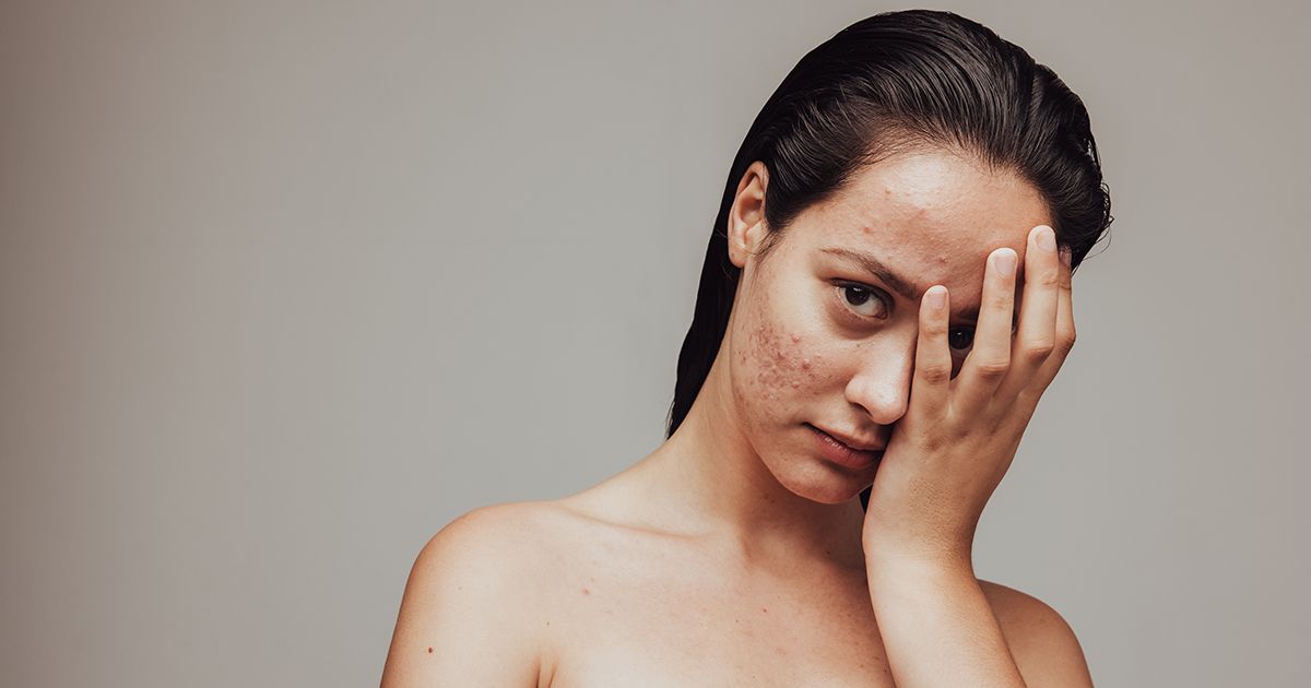 Comment pouvez-vous traiter l'acné de manière naturelle ?