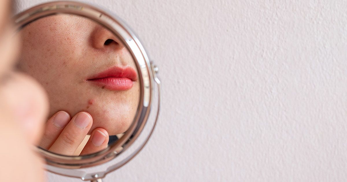 Comment se débarrasser des cicatrices d'acné