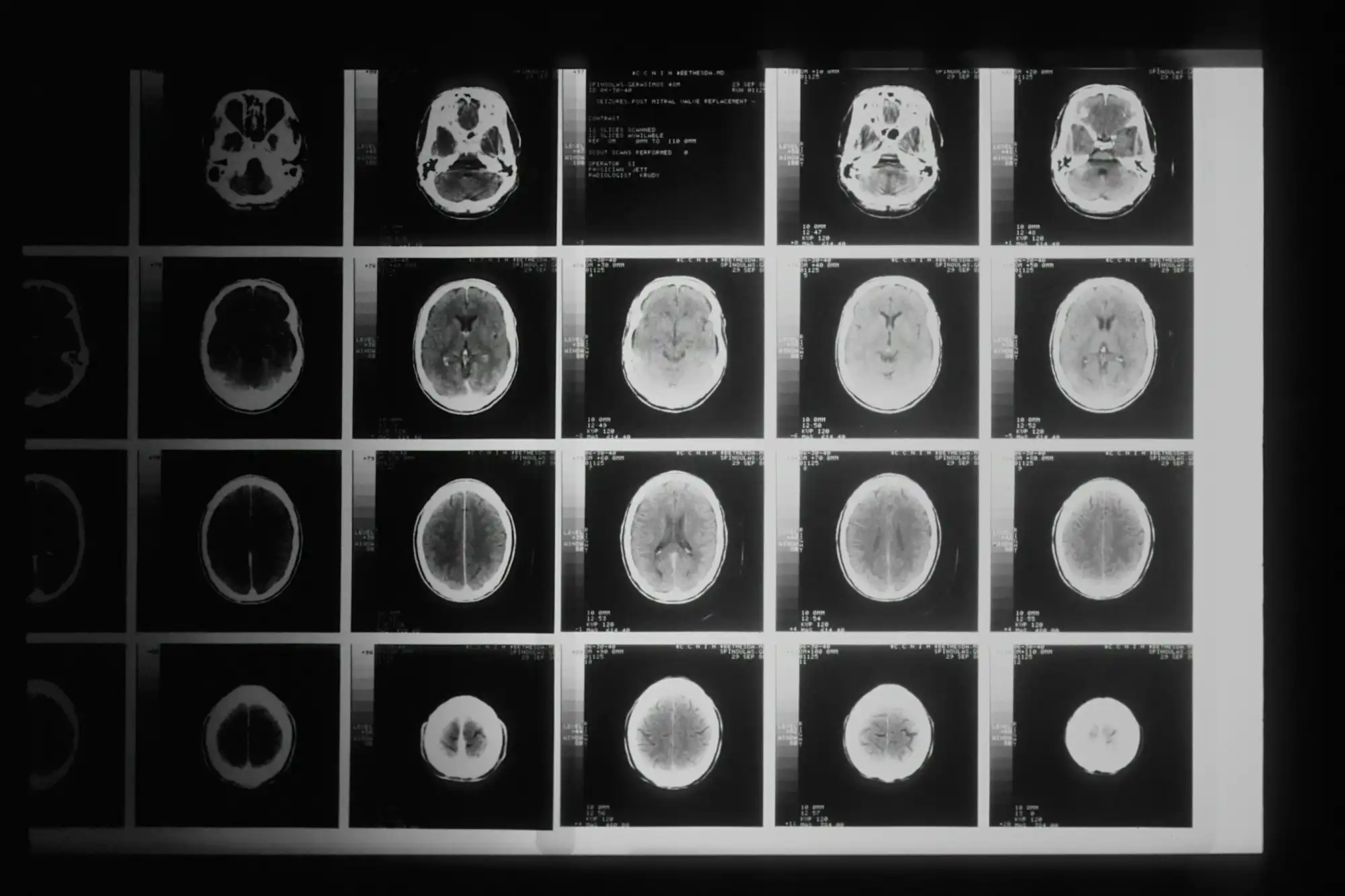 Les effets antitumoraux de la quercétine