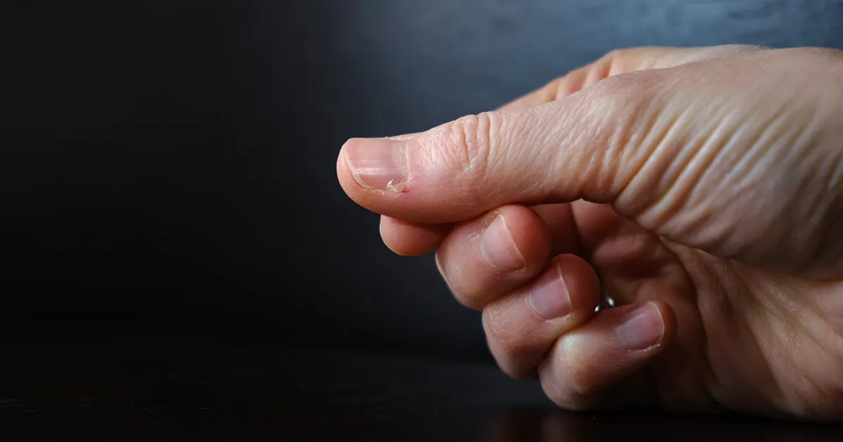 Ces petites peaux gênantes peuvent revenir sans cesse si vous ne faites pas attention