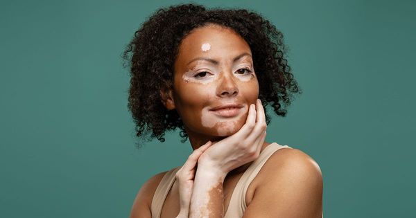 Comment pouvez-vous aider à gérer le vitiligo naturellement ?