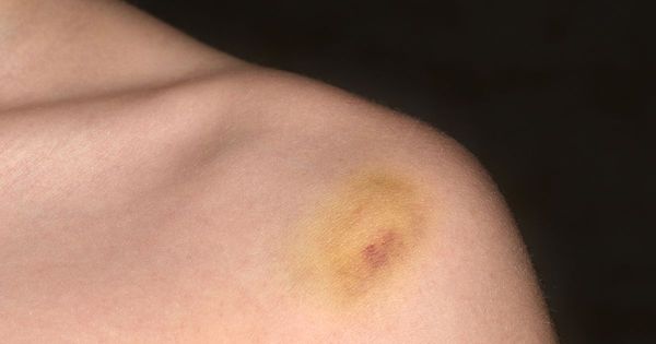 Ce type d'ecchymose doit-il vous inquiéter ?