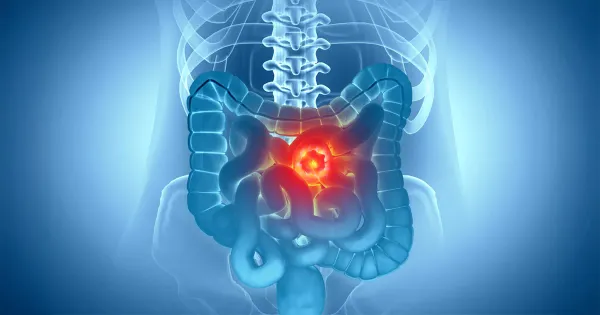 Cette habitude quotidienne pourrait favoriser un terrain propice au cancer