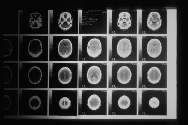 Les effets antitumoraux de la quercétine